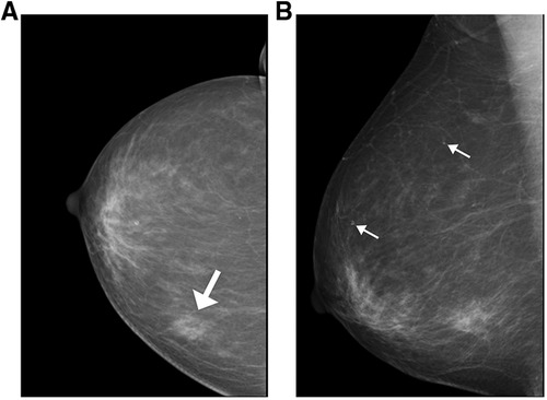 Association of Microcalcification Clusters with Short-term Invasive Breast  Cancer Risk and Breast Cancer Risk Factors