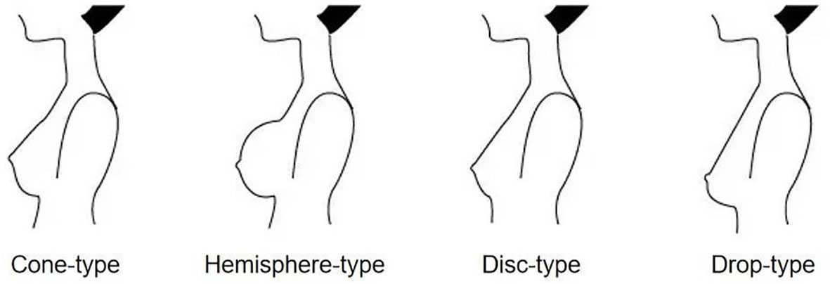 The 12 Different Breast Shapes and Types