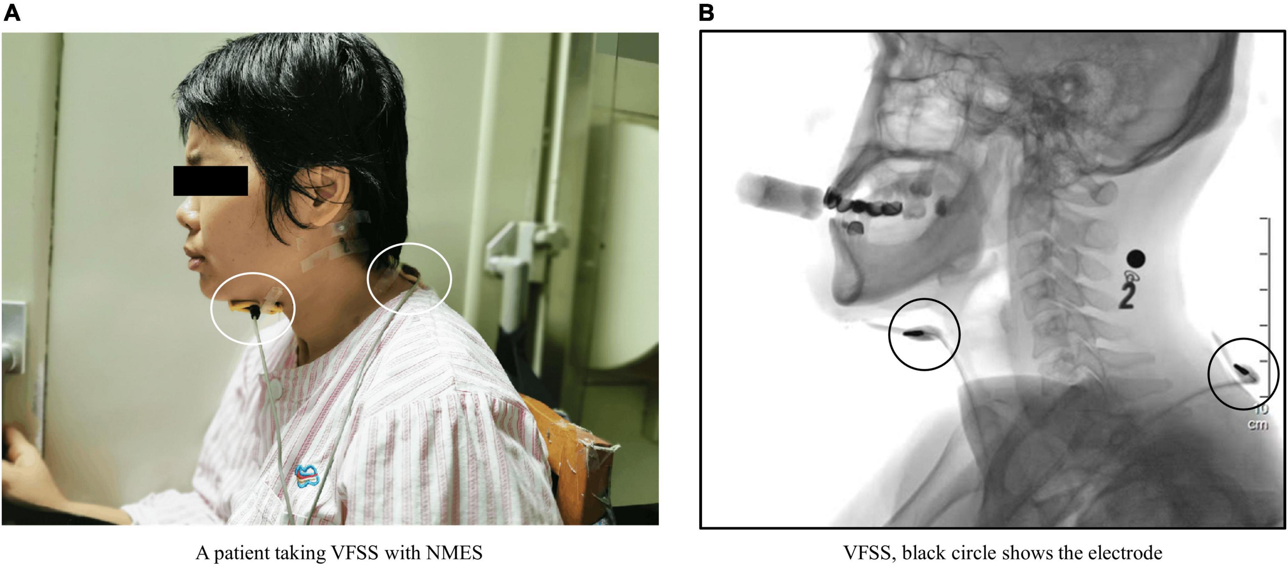 Frontiers  Neuromuscular electrical stimulation improves swallowing  initiation in patients with post-stroke dysphagia