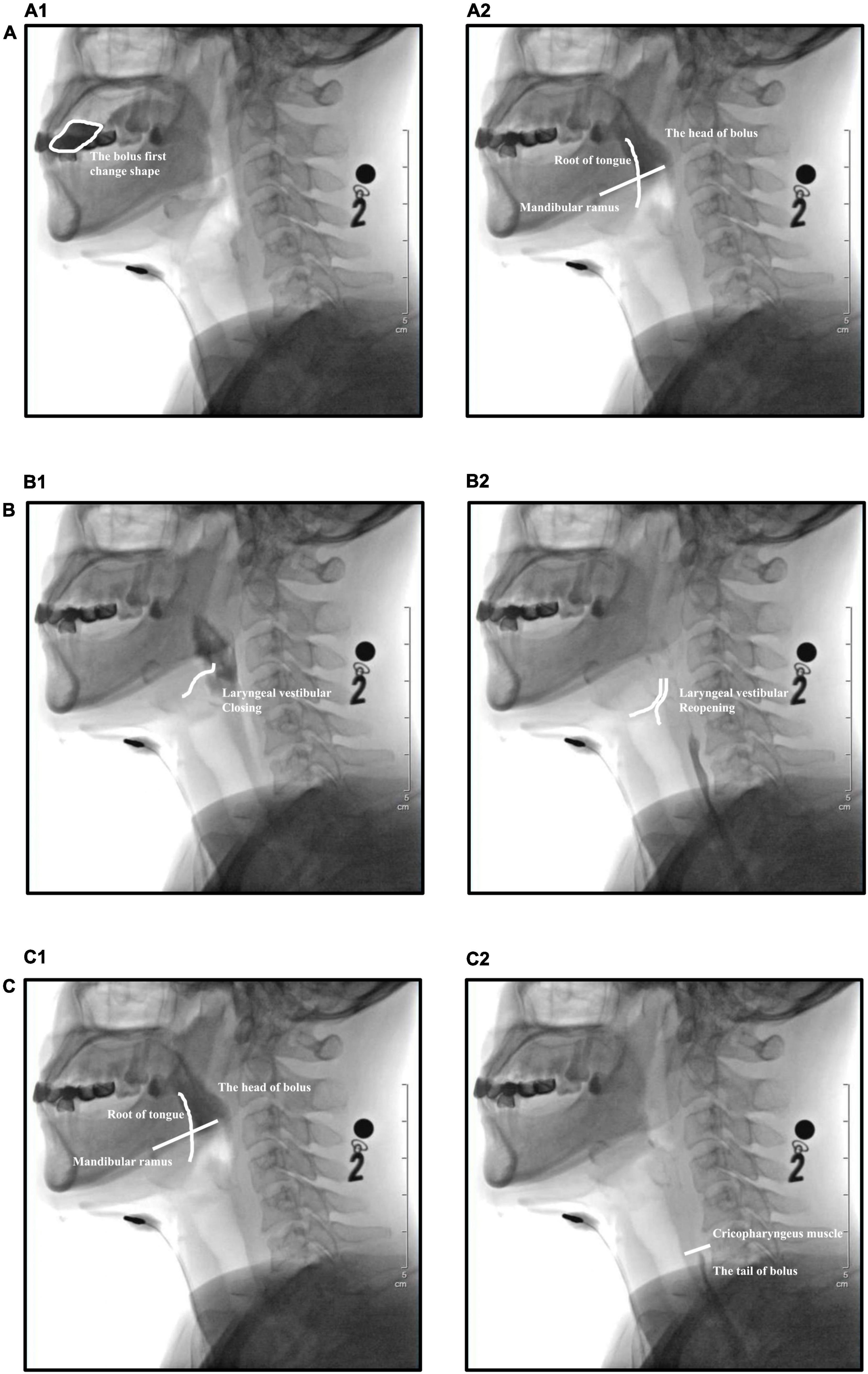 Treating Swallowing Disorders With Neuromuscular Electrical Stimulation