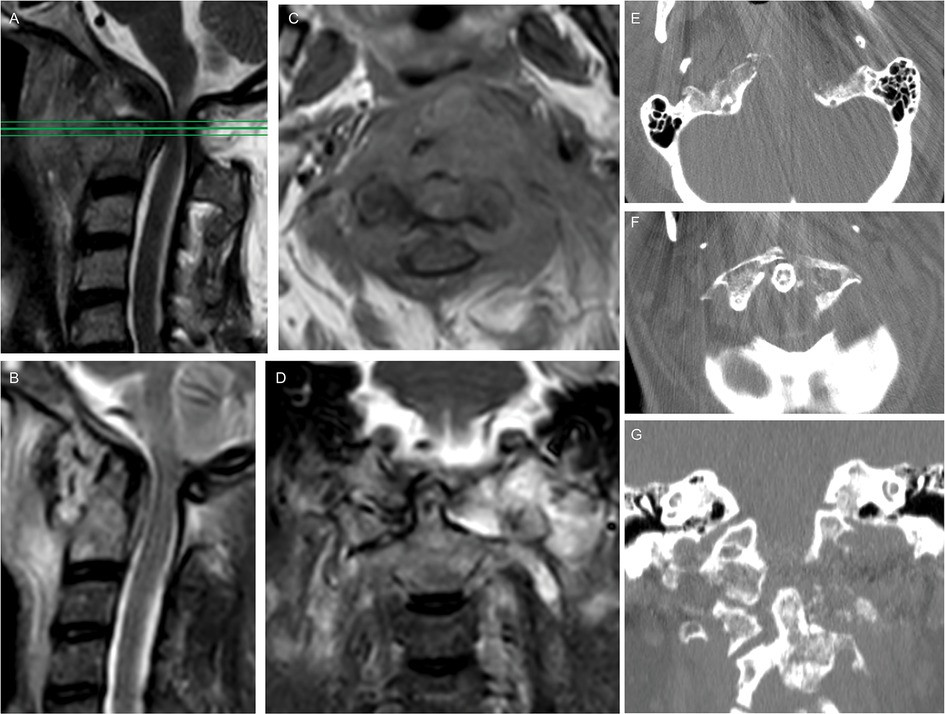 Frontiers 3D printed Guides For Cervical Pedicle Screw Placement In 