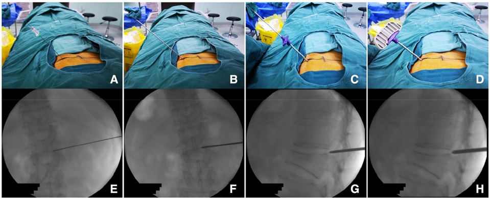 Frontiers | A modified trajectory of kyphoplasty via superior pedicle ...