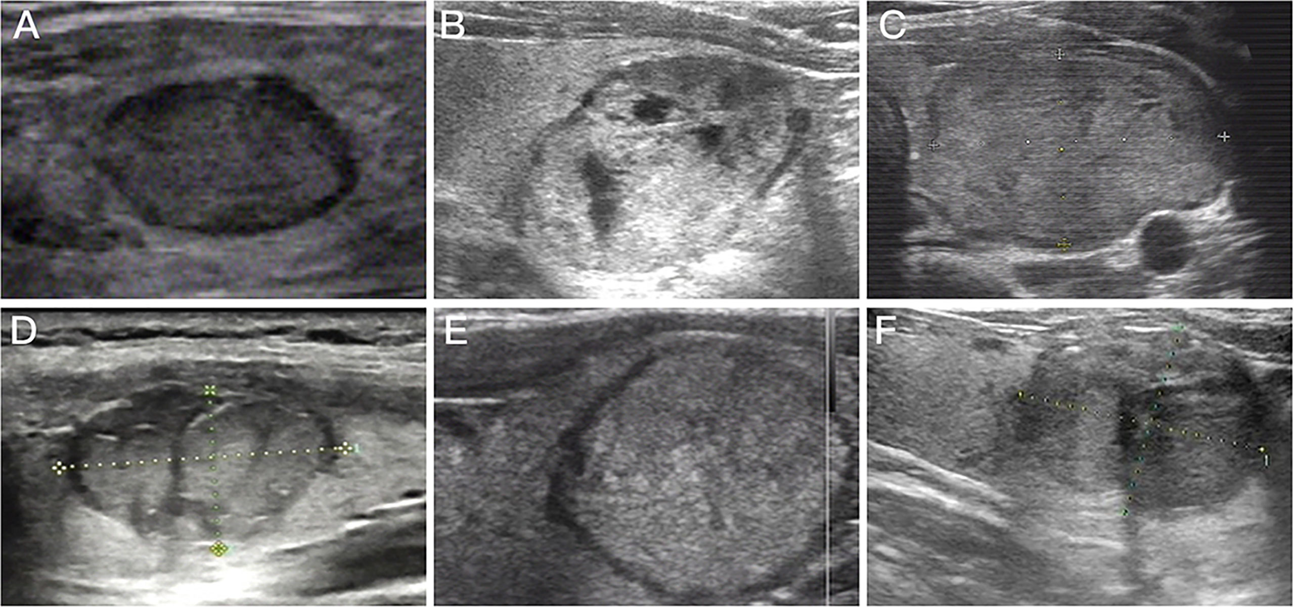 Follicular Adenoma Thyroid Ultrasound follicular-adenoma-thyroid-ultrasound