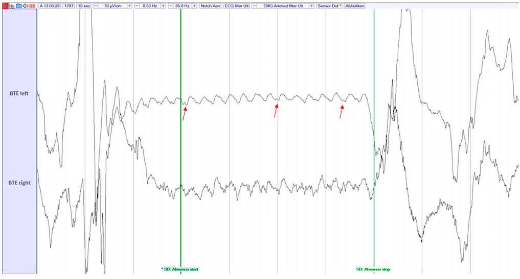 Frontiers Multimodal detection of typical absence seizures in home