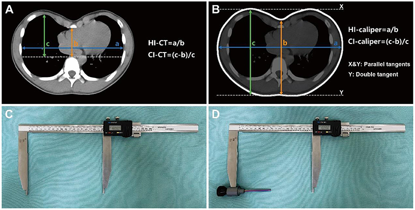 Breast anthropometric results for the following indexes: distance from