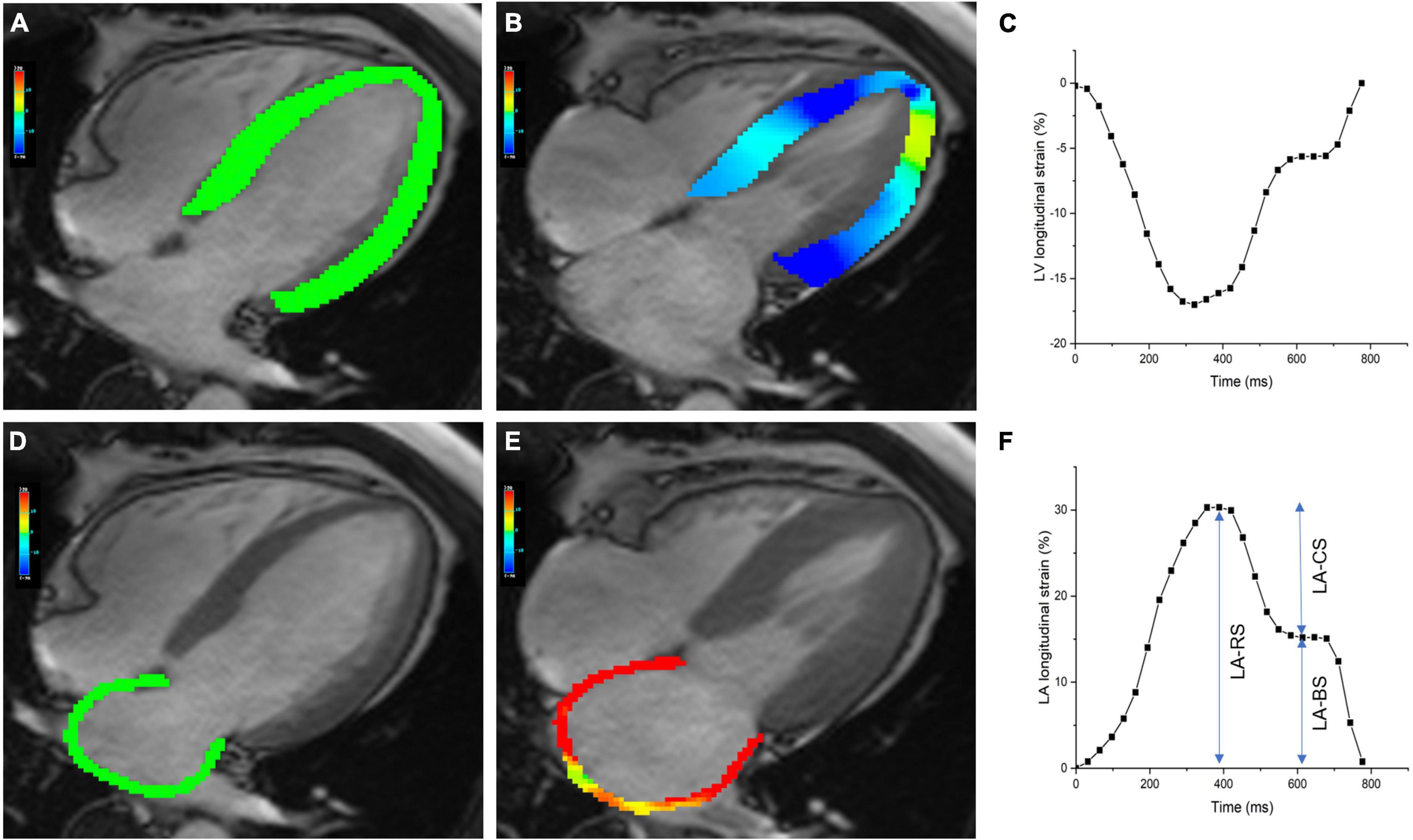 ASDAS states in patients stratified by baseline MRI/CRP status.