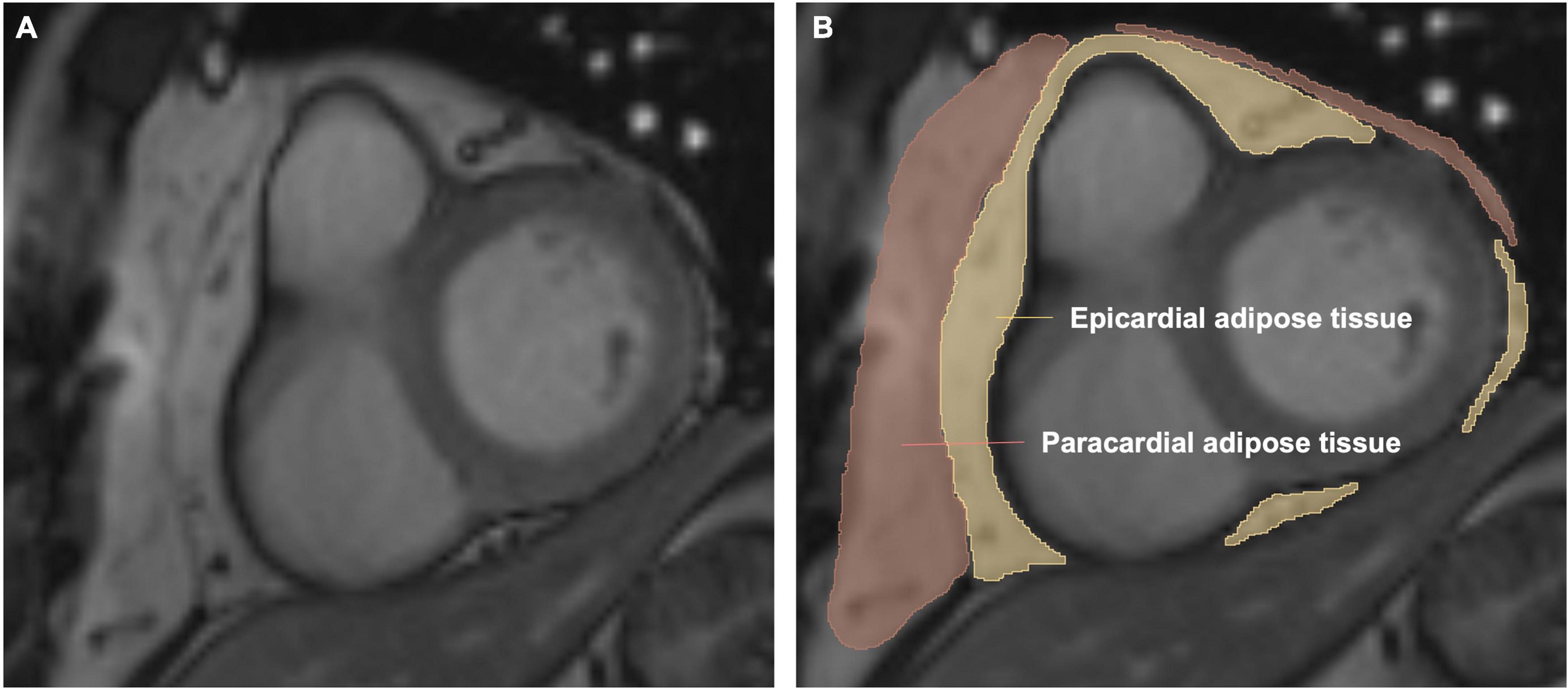 Frontiers  Deleterious Effects of Epicardial Adipose Tissue