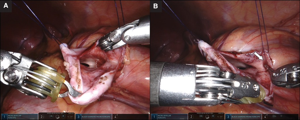 Inguinal Hernia  CUHK Medical Centre Limited