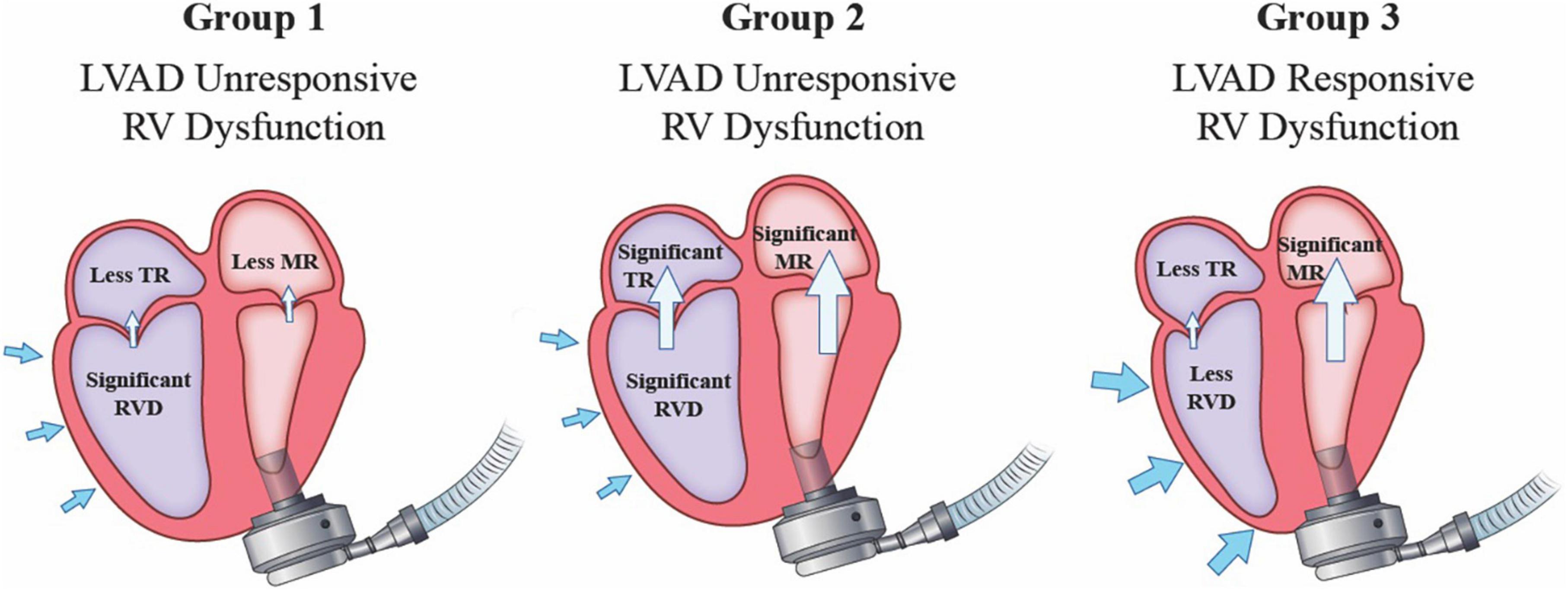 Lvad