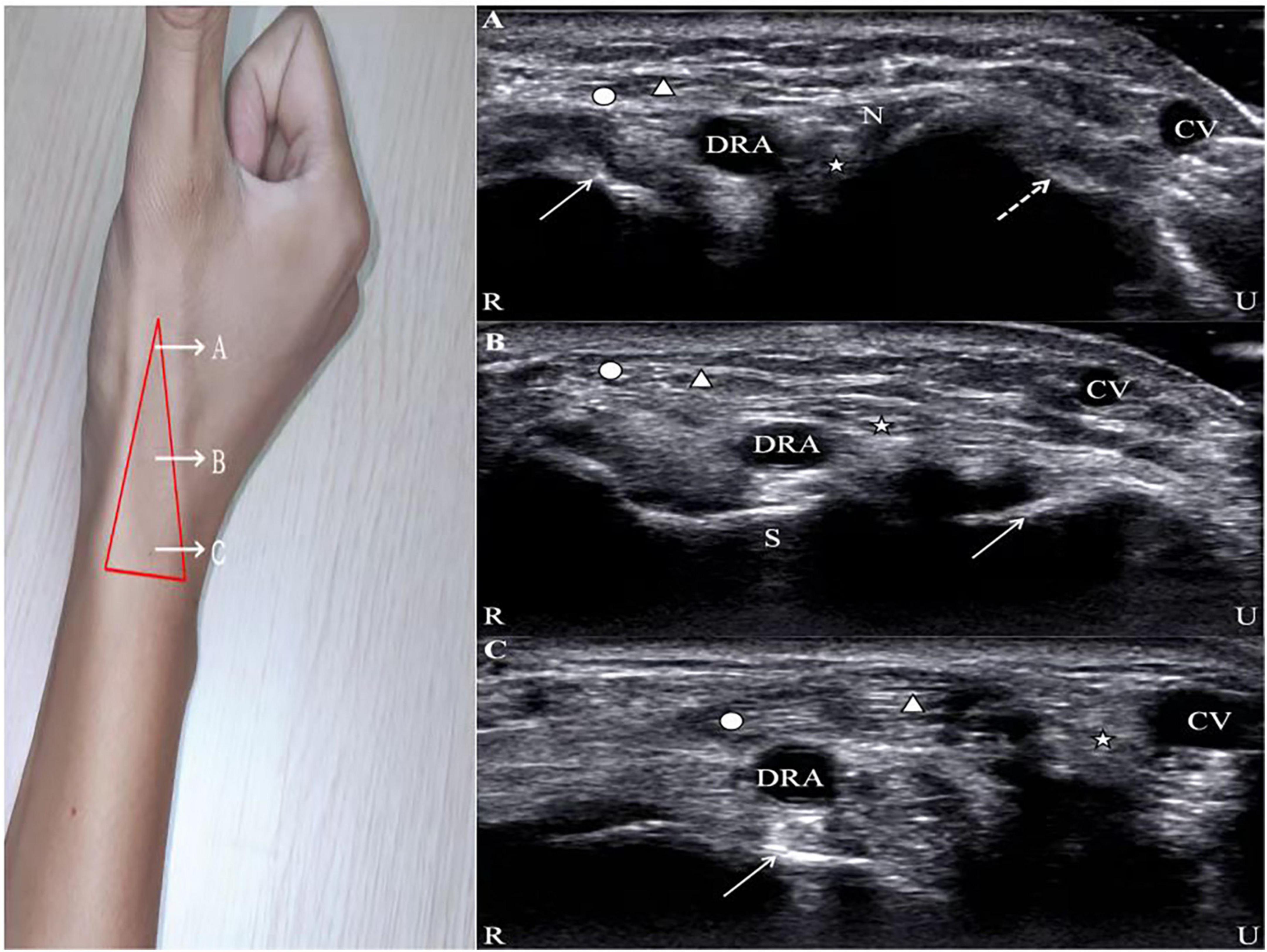 Anatomical snuff box, Radiology Reference Article