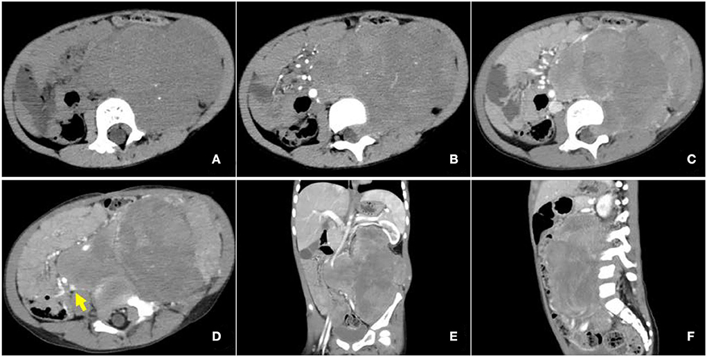Frontiers | Retroperitoneal alveolar rhabdomyosarcoma intruding into