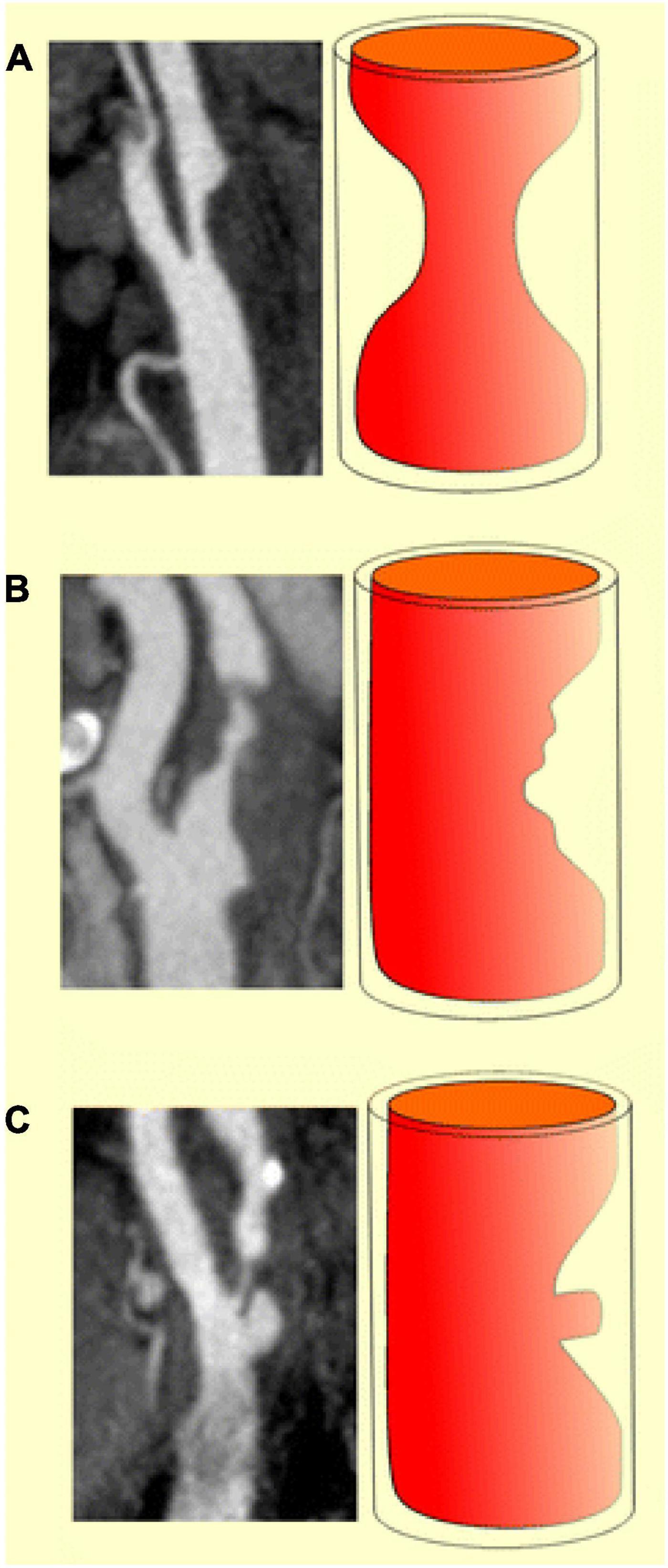 Frontiers | The utility of ultrasound and computed tomography in the  assessment of carotid artery plaque vulnerabilityâ€“A mini review