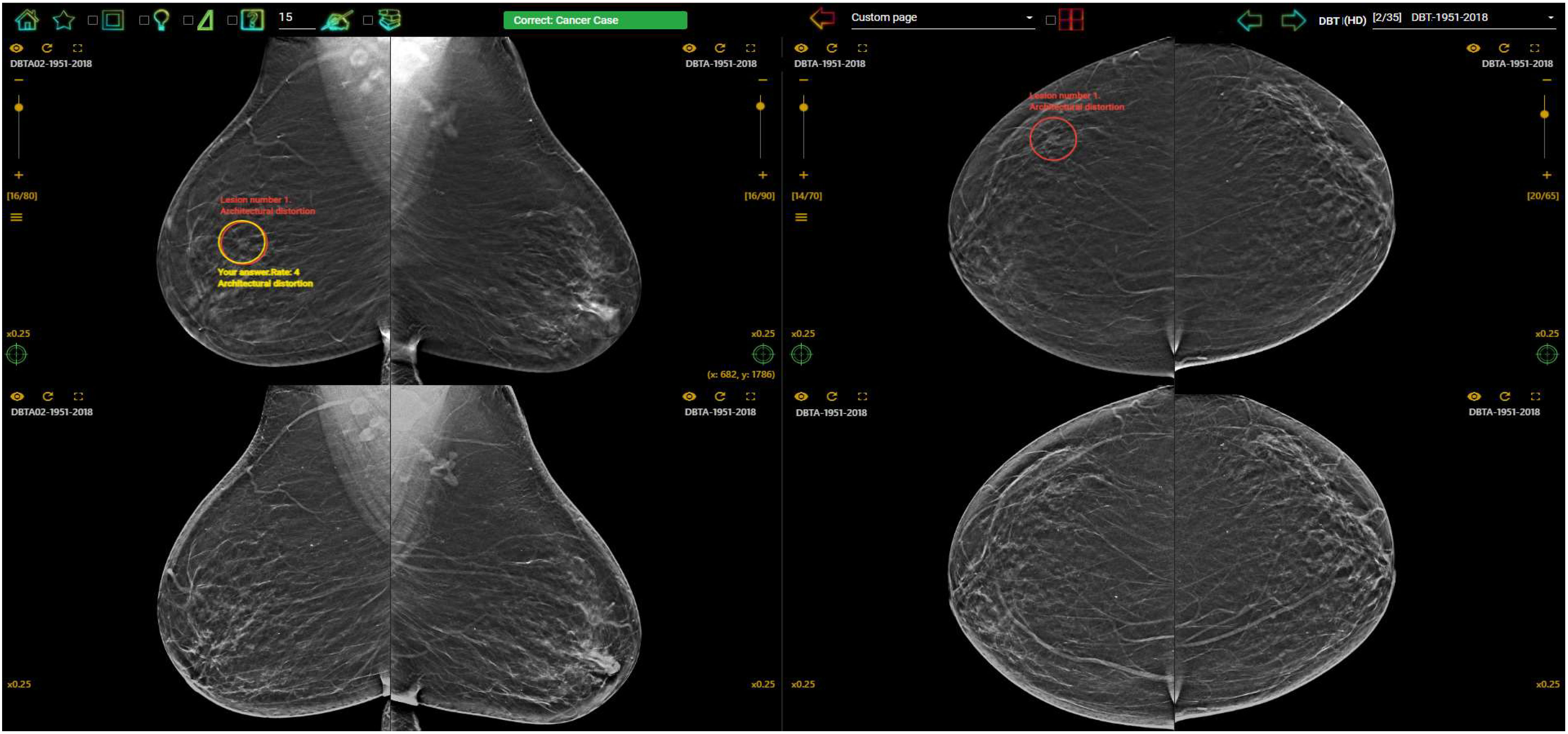 Determinants of breast size in Asian women