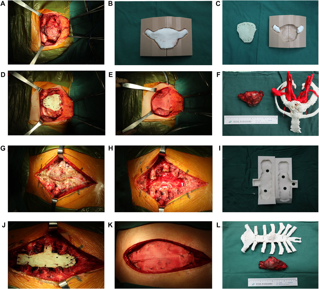 Manubrial Resection and Reconstruction With Iliac Wing Bone Autograft -  ScienceDirect