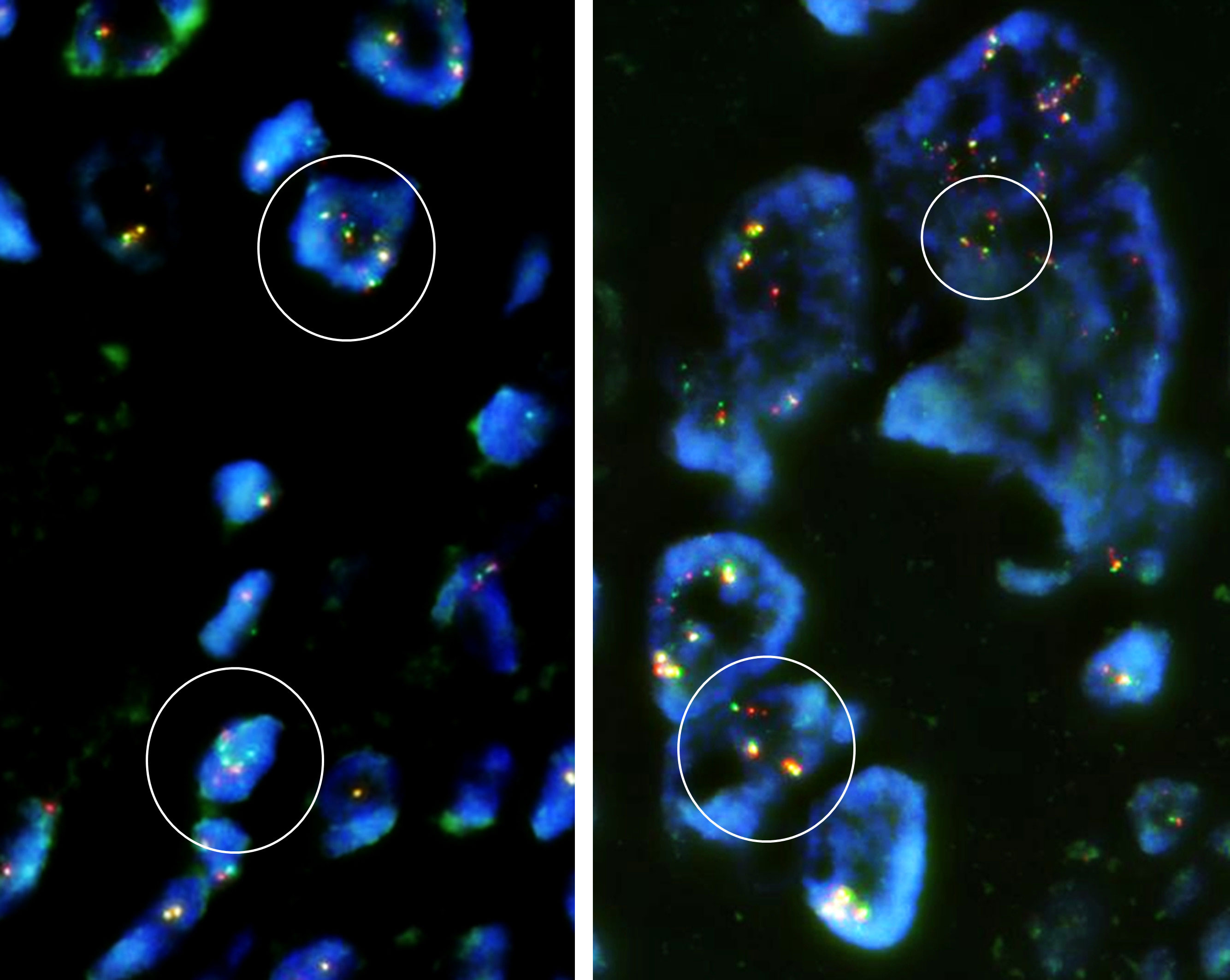 Frontiers Case Report Extraskeletal Osteosarcoma With Preceding