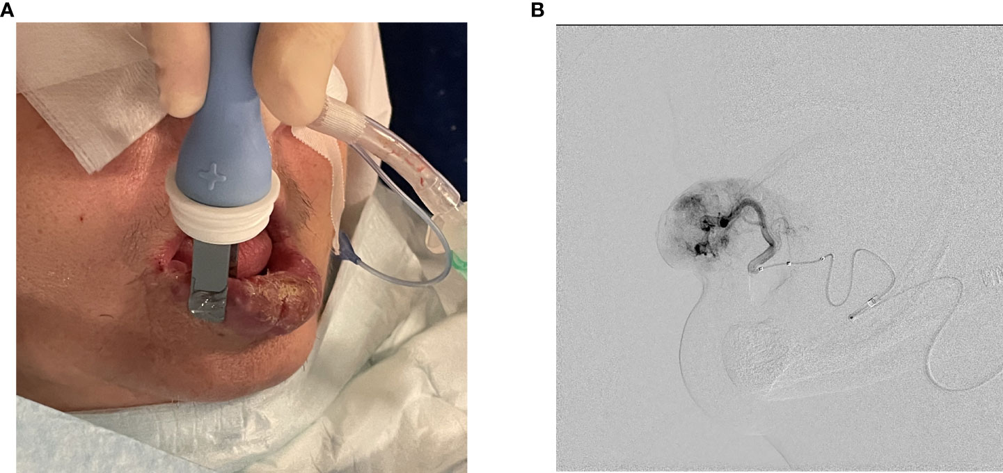 Frontiers  Combining superselective catheterization and