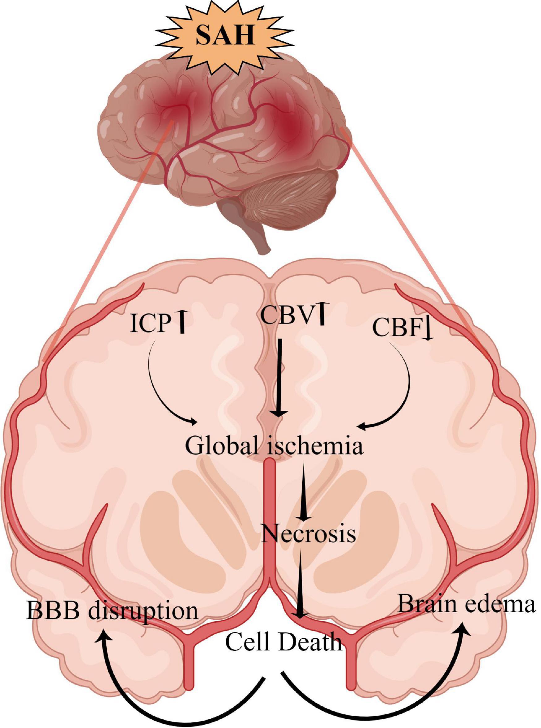 SAH Management Algorithm – Peripheral Brain