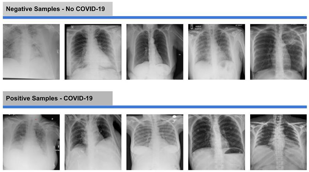 Frontiers | CCTCOVID: COVID-19 detection from chest X-ray images using ...