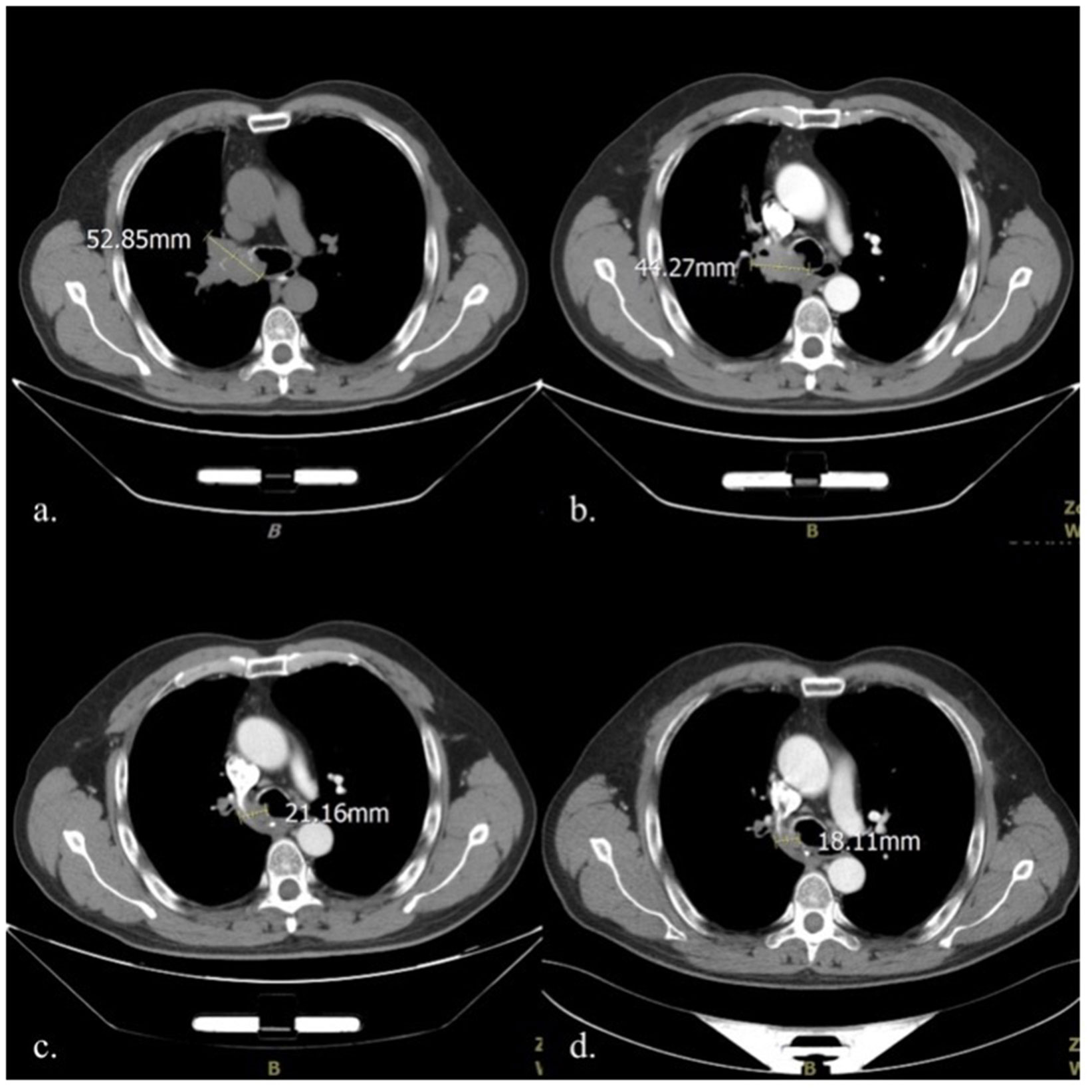 Lung Cancer and Hemoptysis: When to Take Action