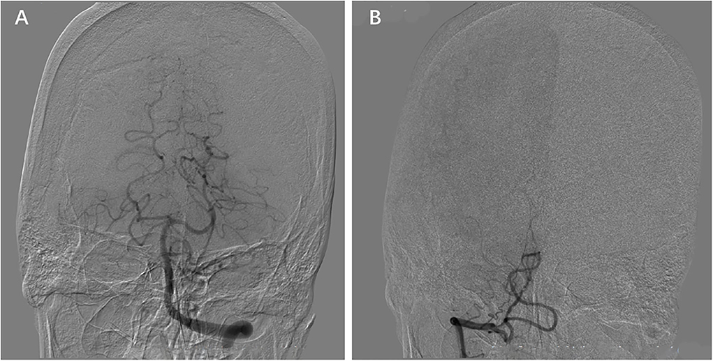 Surgery of Posterior Inferior Cerebellar Artery (PICA) Aneurysm