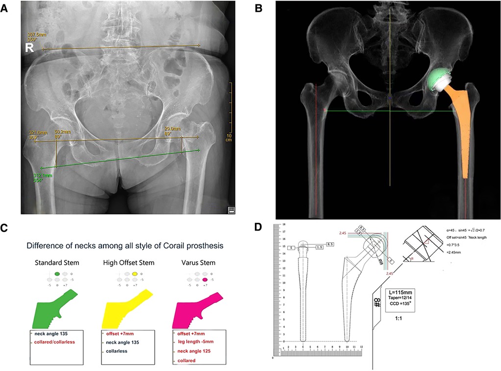 T Scope Hip Tip No. 09 - Fitting the Thigh 