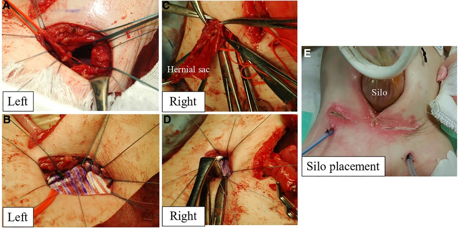 Frontiers  Case report: A giant bilateral inguinal hernia requiring  artificial mesh and multi-stage surgery in infancy; hernioplasty with silo  placement to prevent acute compartment syndrome