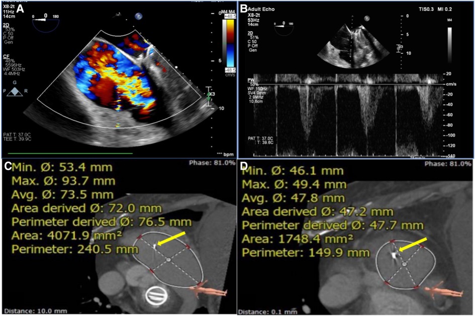 Frontiers Treatment Of Severe Tricuspid Regurgitation Induced By