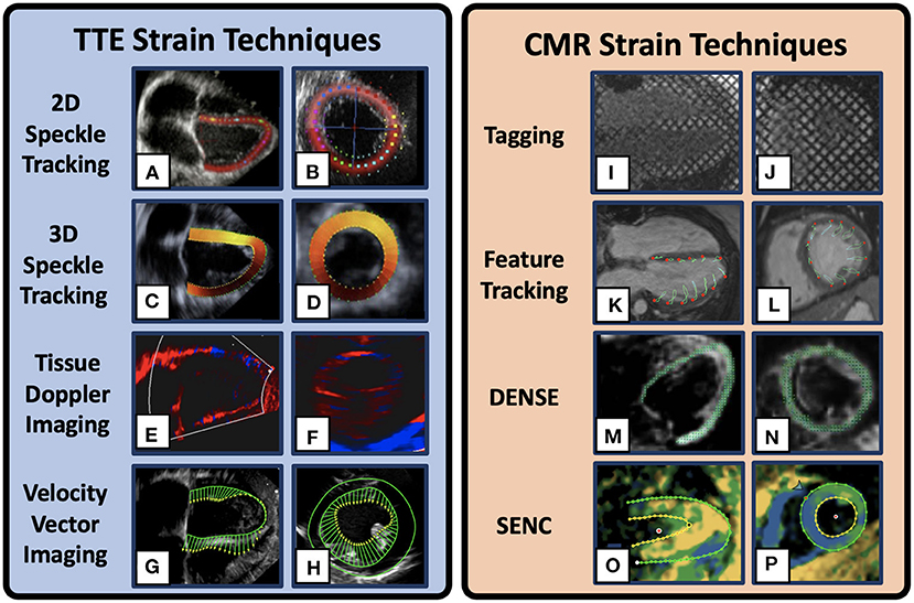 Myocardial Deformation Imaging