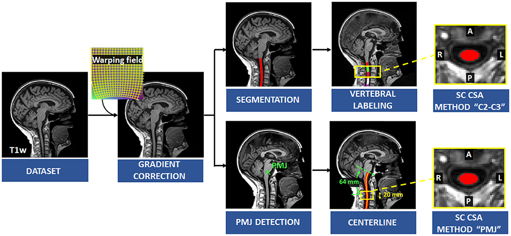 The anterior cervical approach to the spine (cross-sectional view)