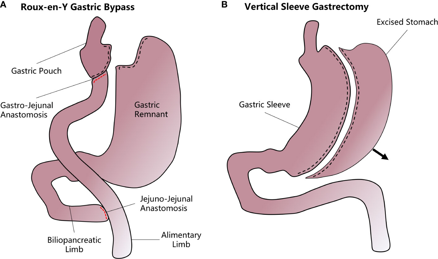 Frontiers Bariatric Surgery Targeting Pancreatic Cells To Treat 