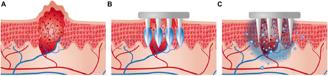 8 MM NEEDLE – IMPROVING SUBCUTANEOUS CHRONIC DRUG DELIVERY - ONdrugDelivery