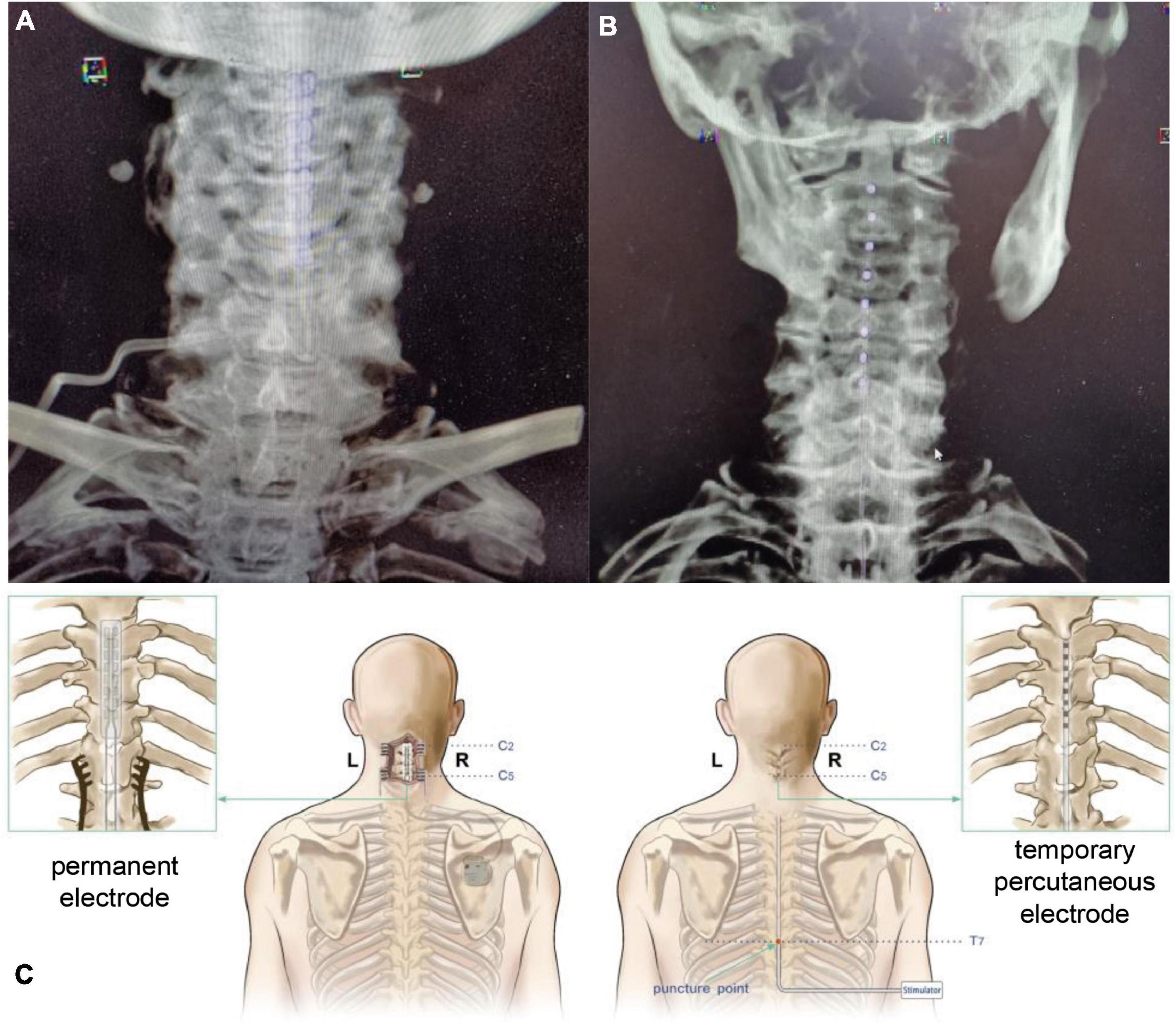 Spinal Cord Stimulation  Cincinnati, OH Mayfield Brain & Spine