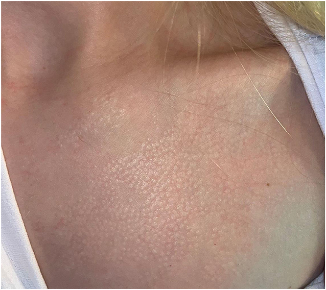 Figure 1 - Small, shiny, smooth bumps on the chest of a patient with lichen nitidus.