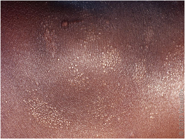 Figure 2 - Lichen nitidus in a patient with a darker skin tone.