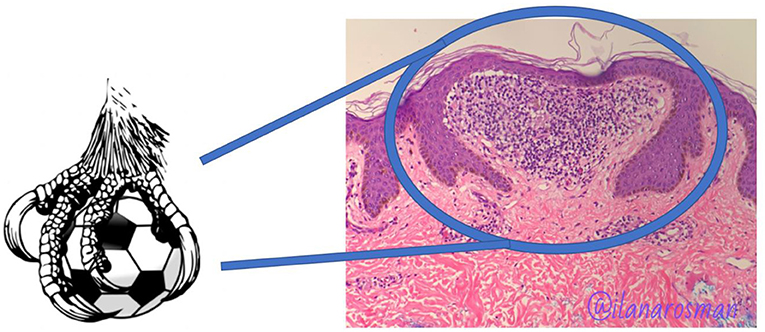 Figure 3 - When skin biopsies taken from patients with lichen nitidus are examined using a microscope, the cells in the skin can often resemble a claw clutching a ball.