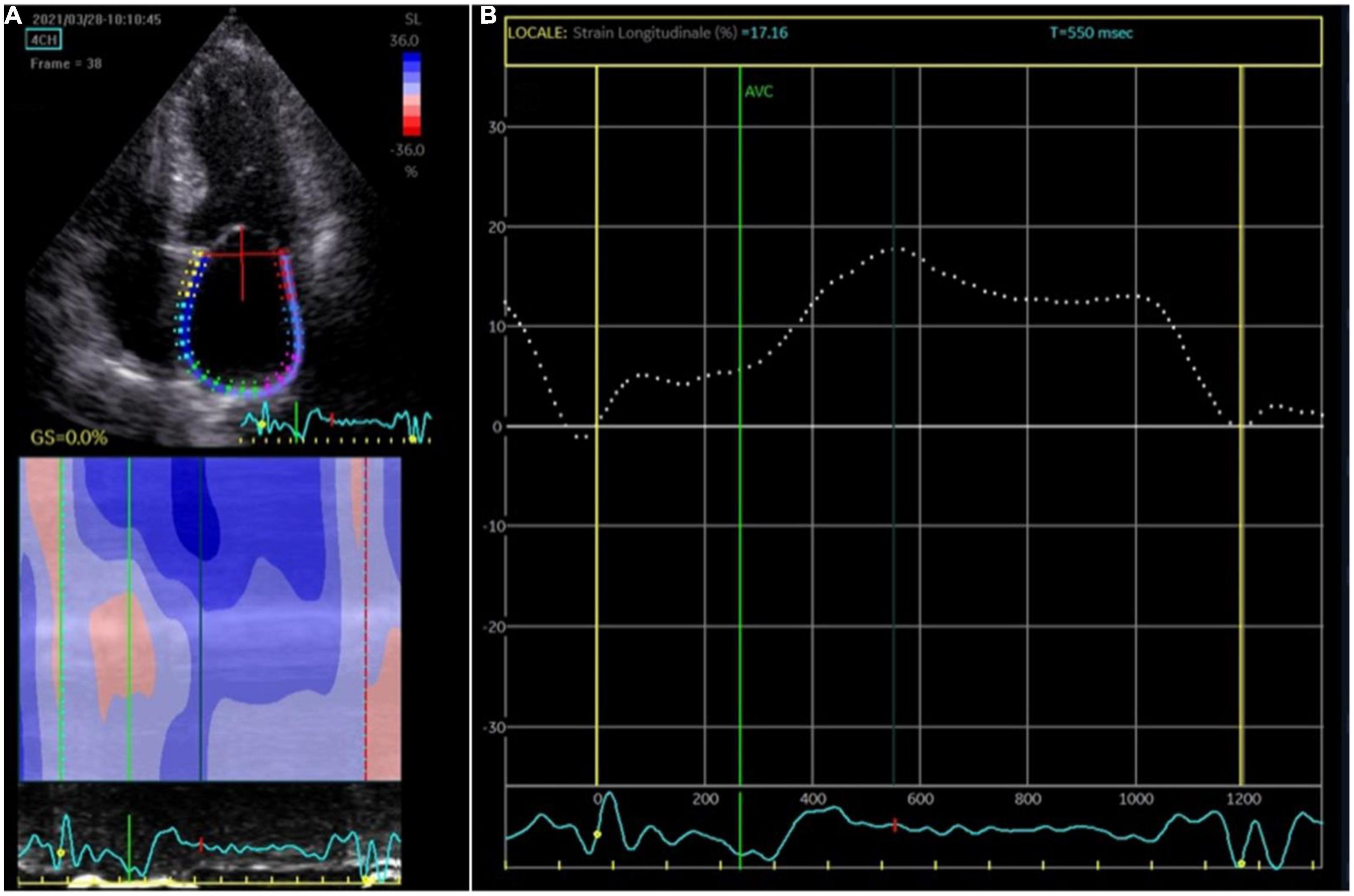 The value of 2D speckle-tracking strain echocardiography in evaluating the  relationship between carotid elasticity and left ventricular systolic  function in patients with diabetic nephropathy, Insights into Imaging