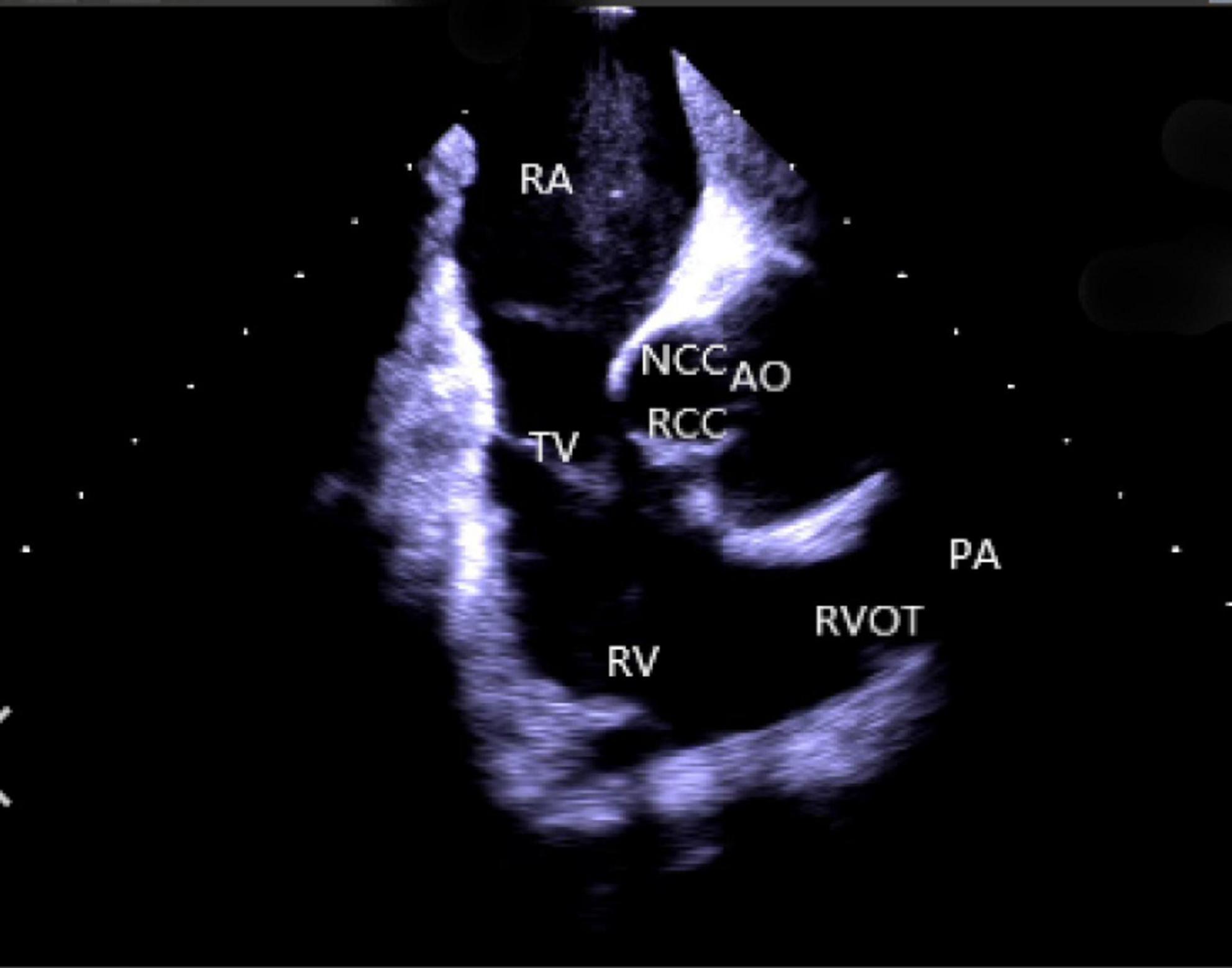 EchoHeart Summit Doppler