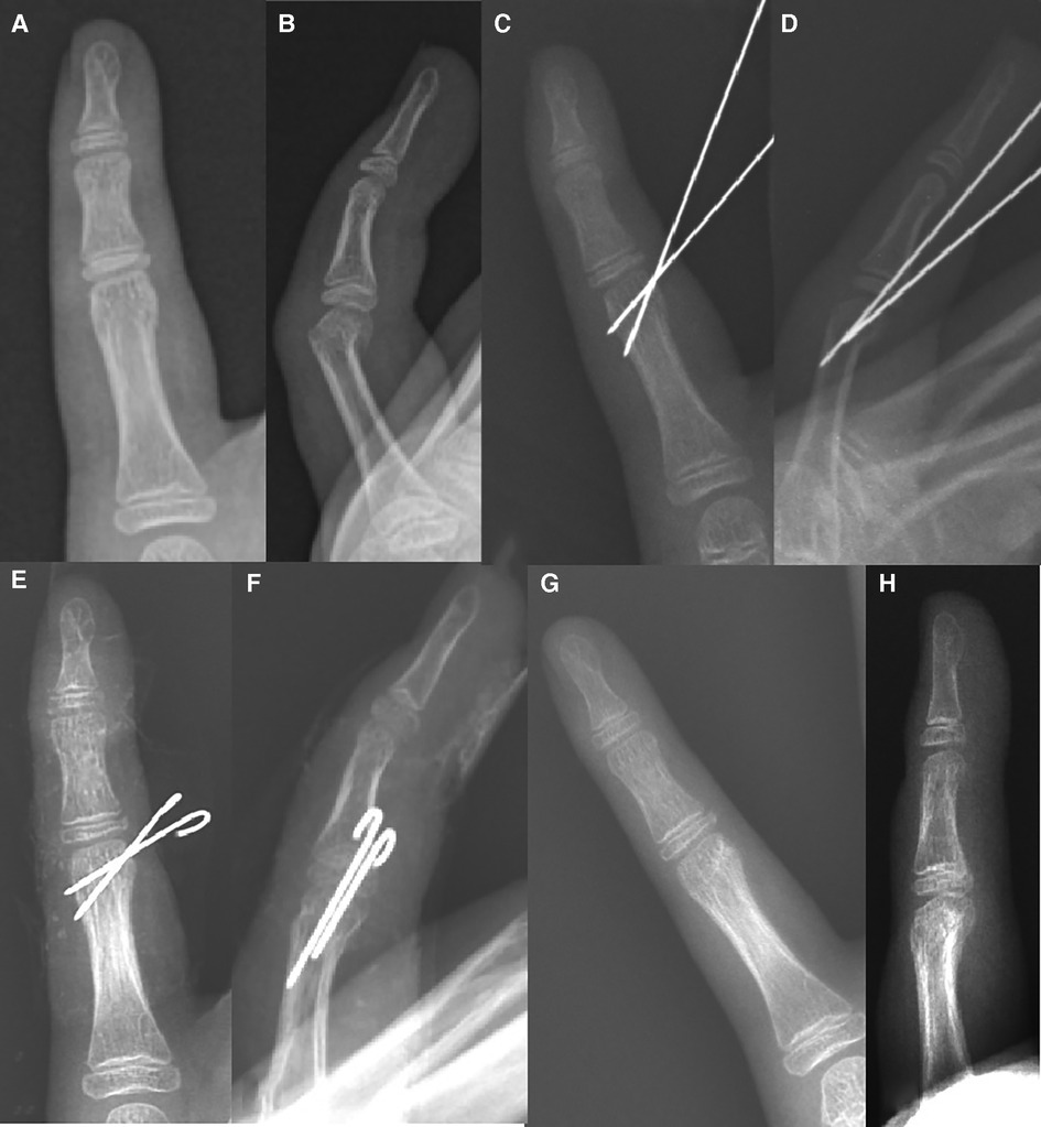 Frontiers | Clinical outcomes of closed, displaced phalangeal neck ...