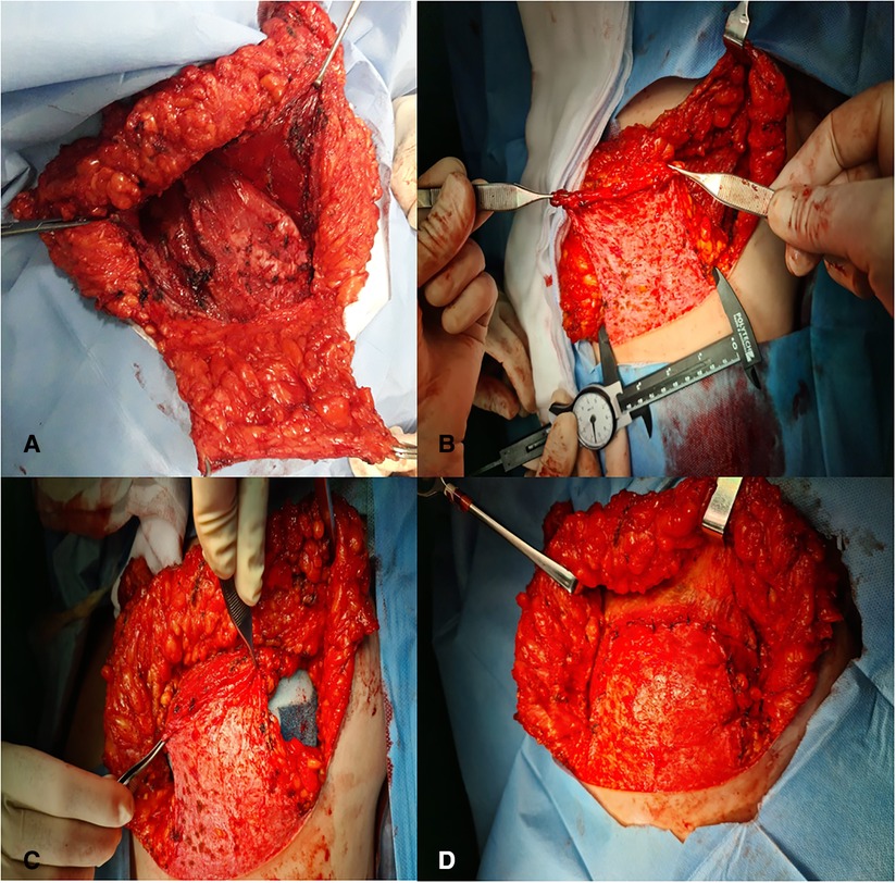 Plastic Surgery Case Study - Rib Removal Results in a Tall Thin