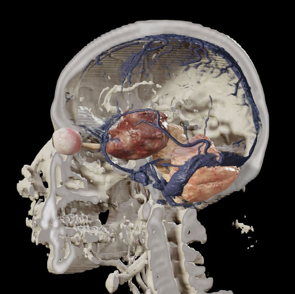 Frontiers | Editorial: Endoscopic transorbital surgery for