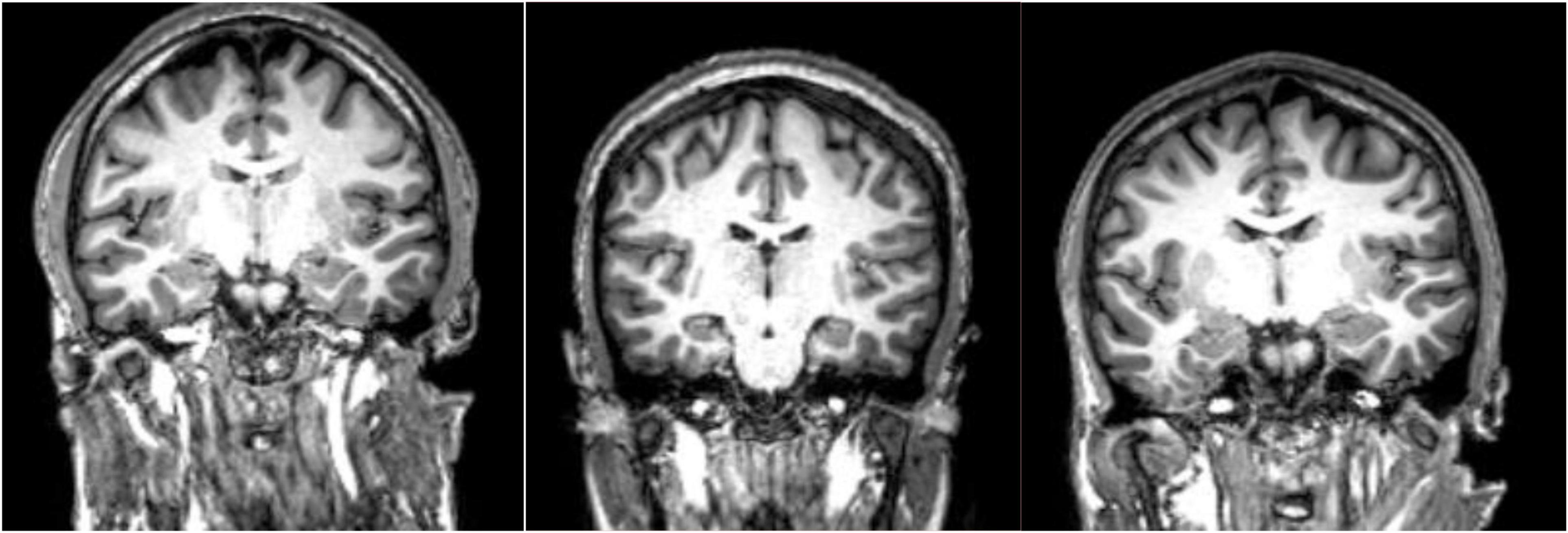 Frontiers Neuroimaging in schizophrenia A review article