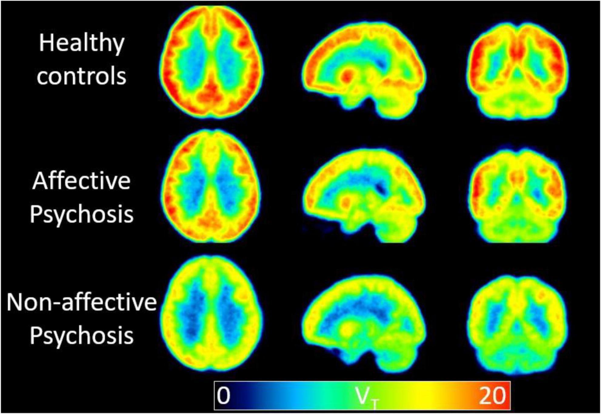 Frontiers Neuroimaging in schizophrenia A review article