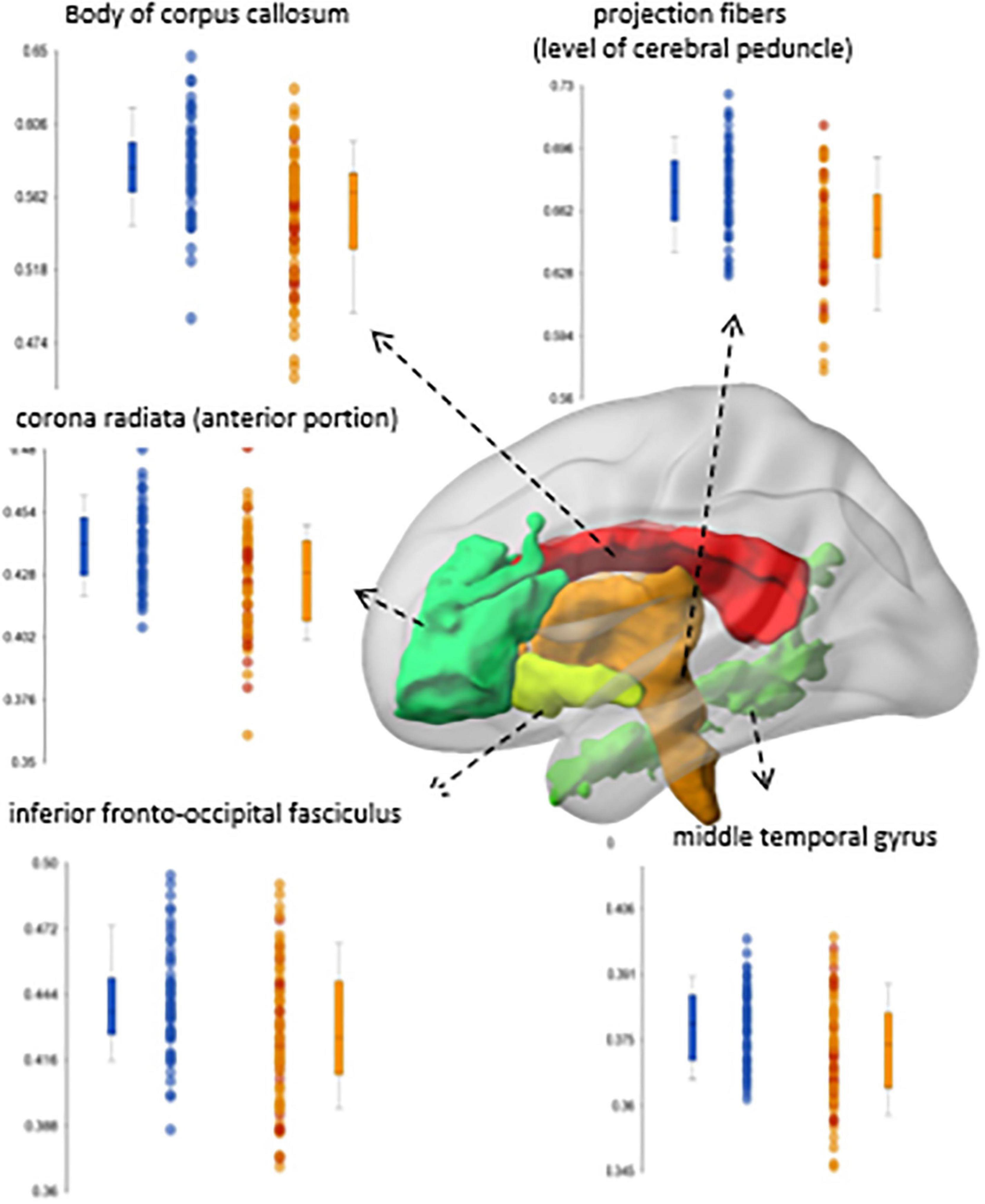 Frontiers Neuroimaging in schizophrenia A review article