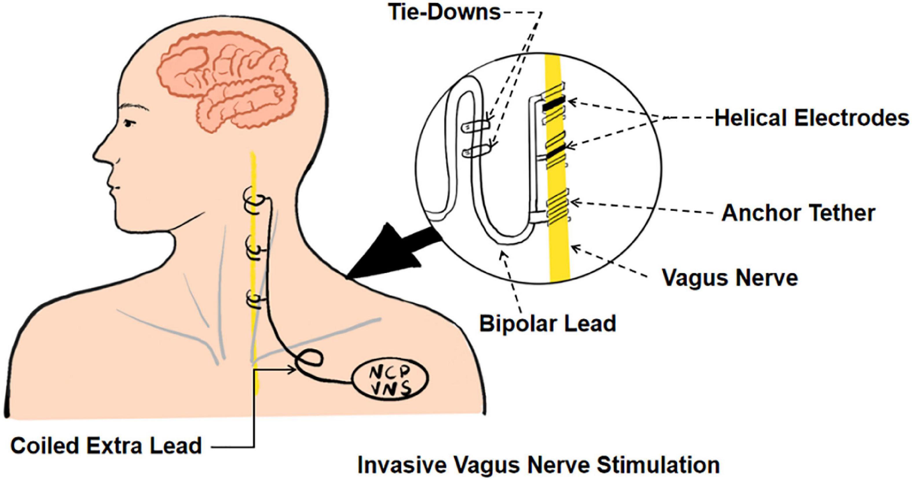 Will Electrical Stimulation Help Me Recover From Stroke?