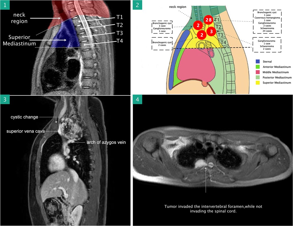 Frontiers Initial Experience With Robotic assisted Thoracic Surgery 