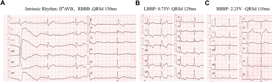 Frontiers  Recruitment of the cardiac conduction system for