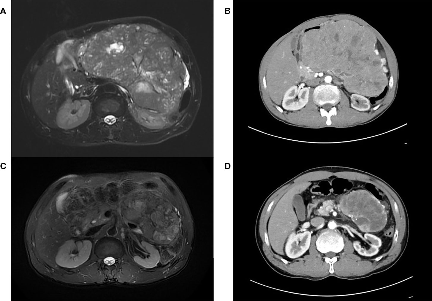 Frontiers | Adaptive Tomotherapy for locally advanced