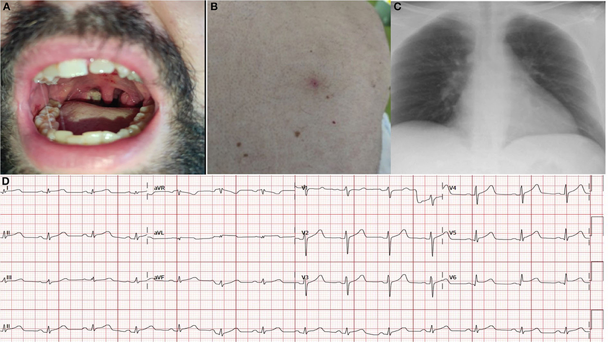 Frontiers Case report From monkeypox pharyngitis to myopericarditis and atypical skin lesions image