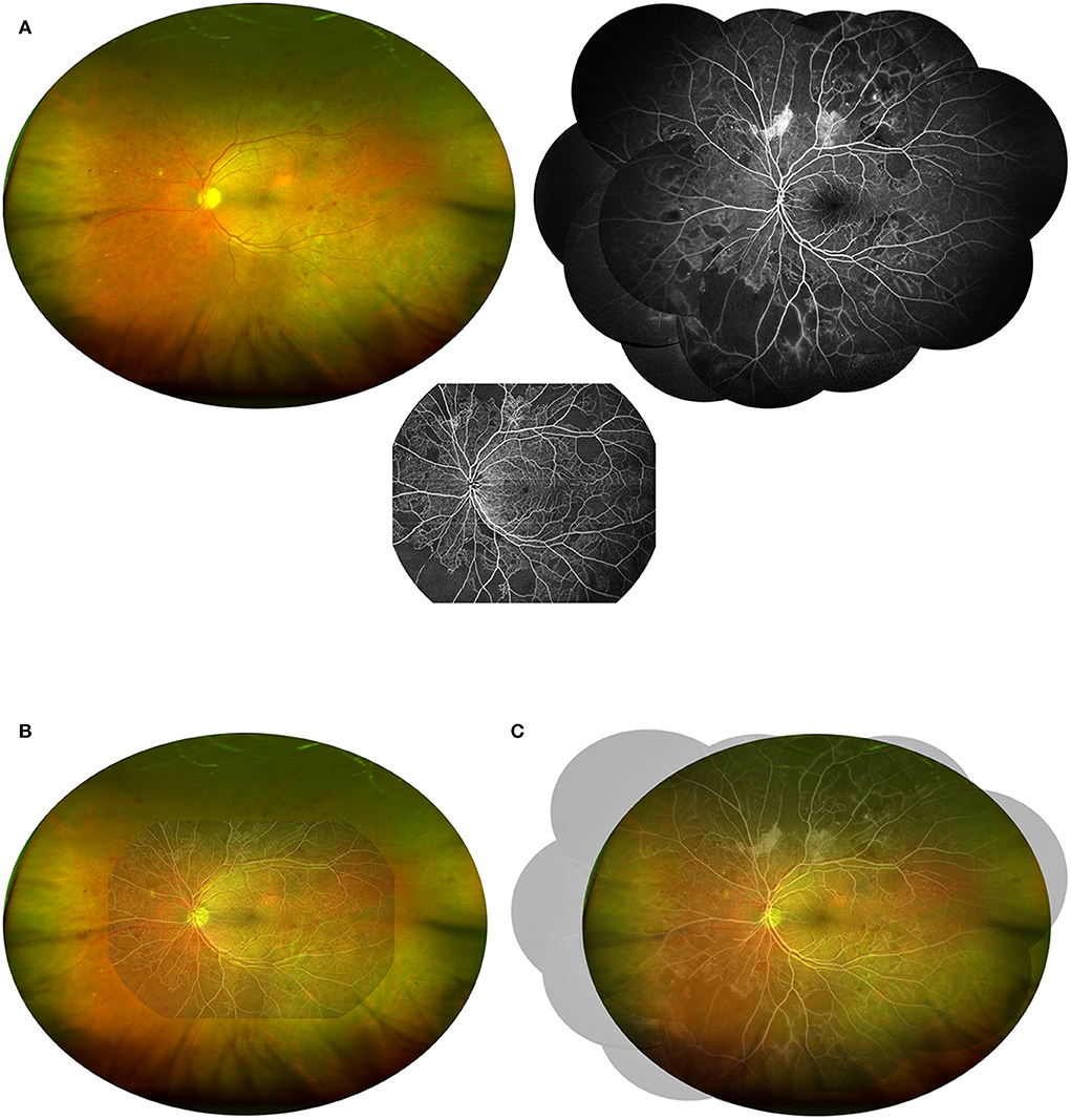 Frontiers  Ultra-widefield color fundus photography combined with  high-speed ultra-widefield swept-source optical coherence tomography  angiography for non-invasive detection of lesions in diabetic retinopathy