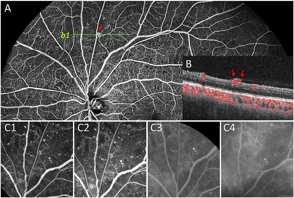 Ultra-wide fundus photograph (UWFP) and optical coherence